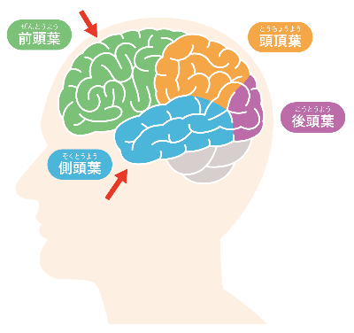 前頭側頭型認知症の人の脳のイメージ