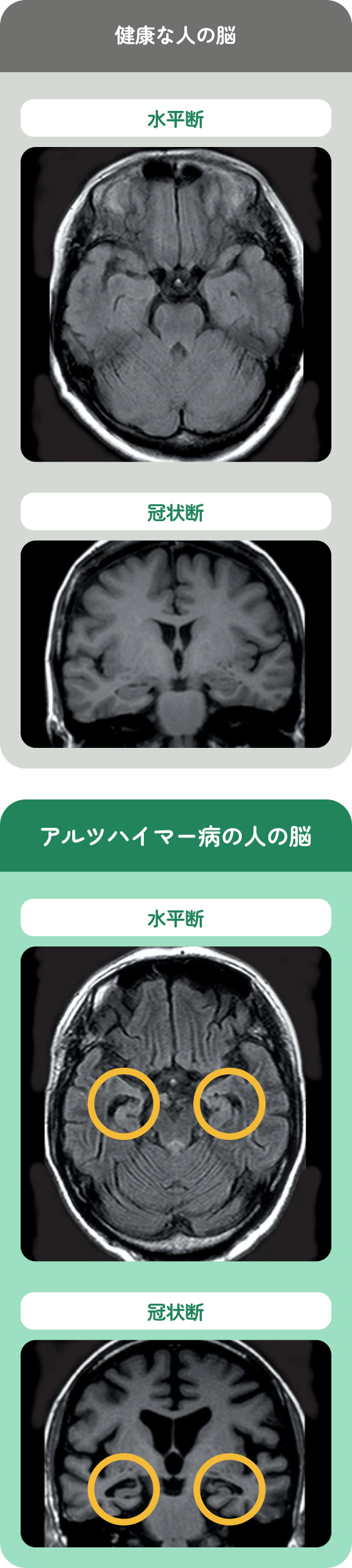 健康な人の脳とアルツハイマー病の人の脳の脳断面図。（それぞれの水平断と冠状断で、脳に違いが見られる）